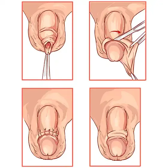 https://enhancedmedical.com/wp-content/uploads/circumcision-tampa.webp