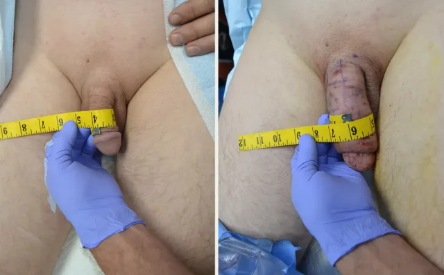 penile-girth-enlargement-before-after