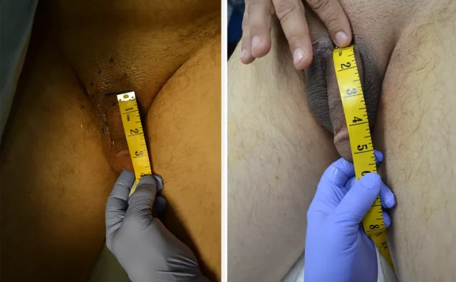 penile-lengthening-procedure-before-after