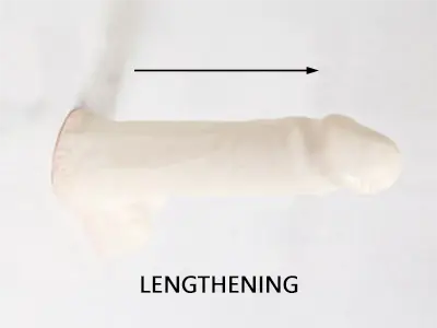 Penile Lengthening Surgery Tampa