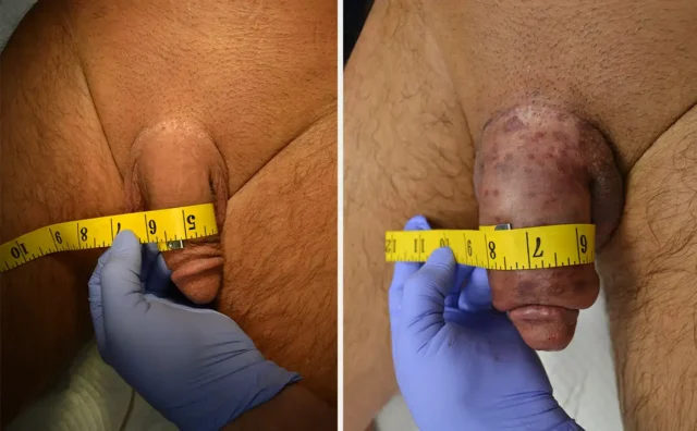 permanent-shaft-girth-before-after