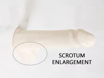 scrotal-enhancement-gainesville-fl Scrotal Enhancement Gainesville FL