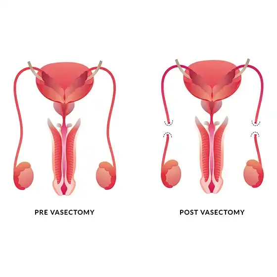 https://enhancedmedical.com/wp-content/uploads/vasectomy-tampa.webp